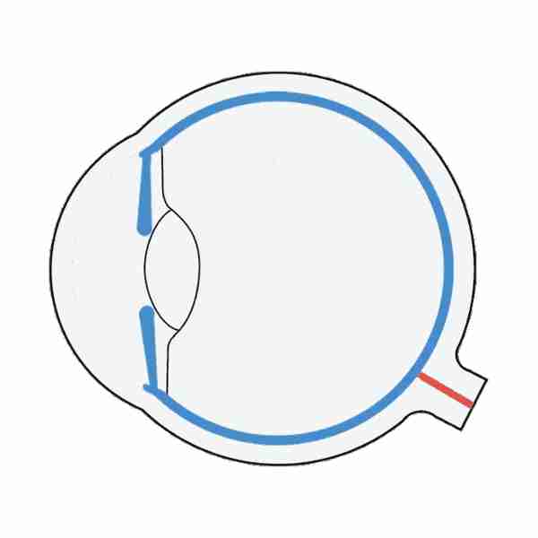 郑州卓美眼科全飞秒激光近视手术怎么做？