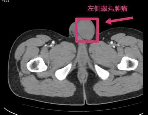 睾丸有癌，多能“摸出来”！不想手术切“蛋”，请看此文